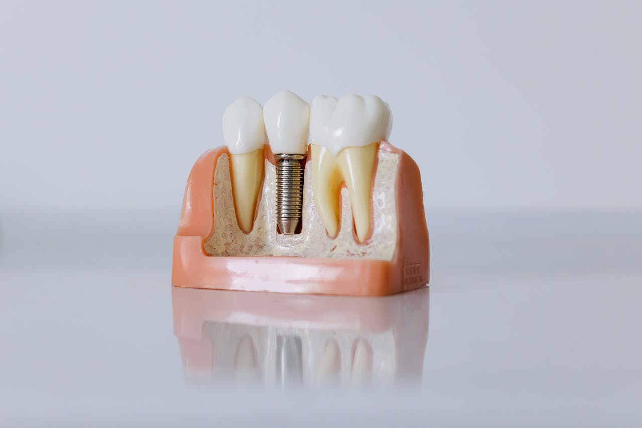Bone Grafting for Dental Implants: When Is It Necessary?