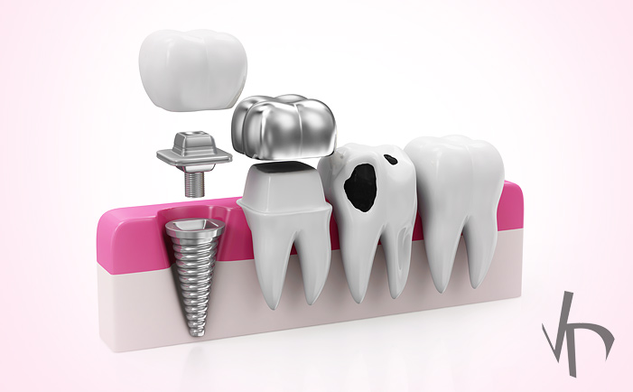 Tooth Filling