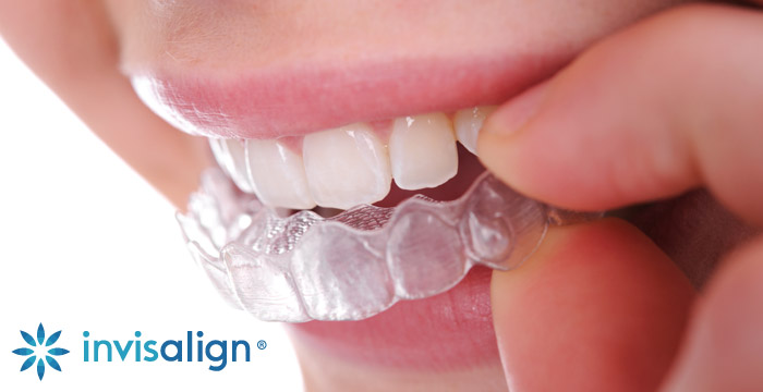 Invisalign – Simple and Effective Way to Straighten Any Teeth Deformation
