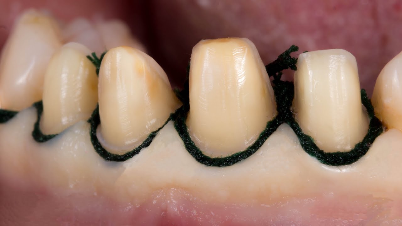 Gingival Retraction in Dentistry: When Is It Necessary?