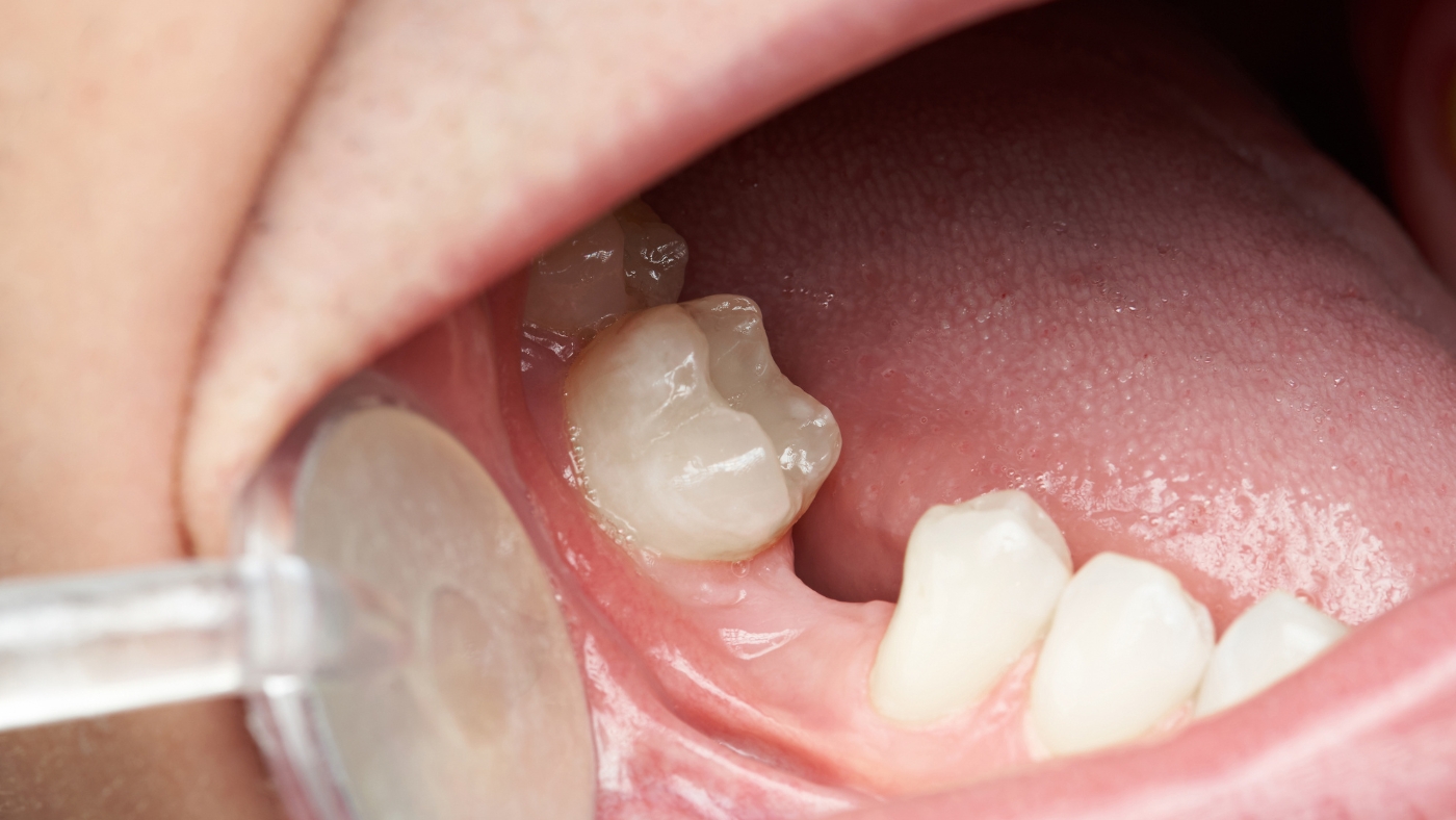 Anodontia (Edentia): Diagnostics, Causes and Treatments