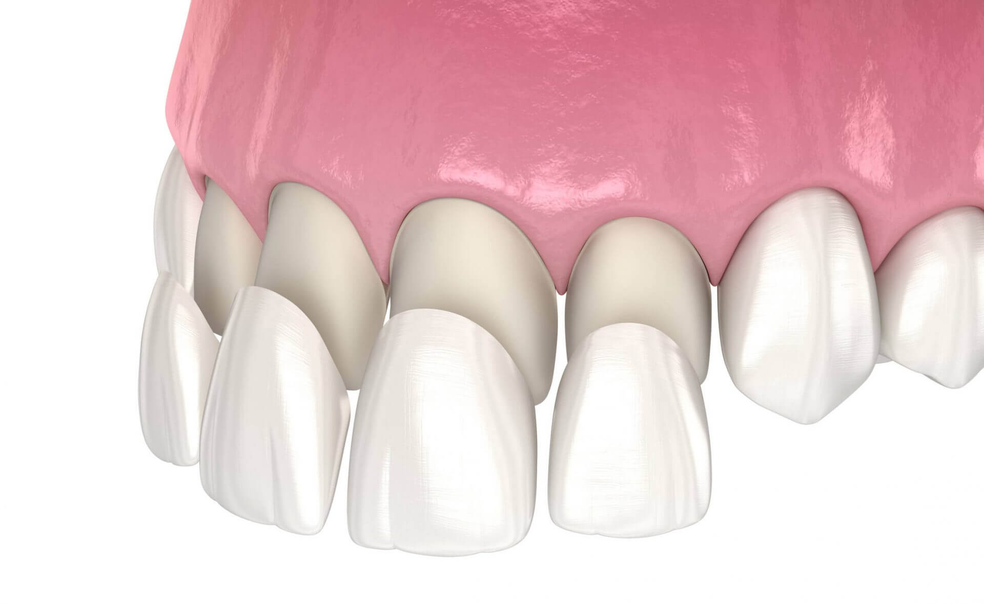 When Is Veneer Replacement Necessary?