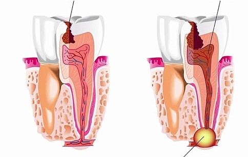 Dental Cyst: Symptoms and Treatment. Types of Dental Cyst