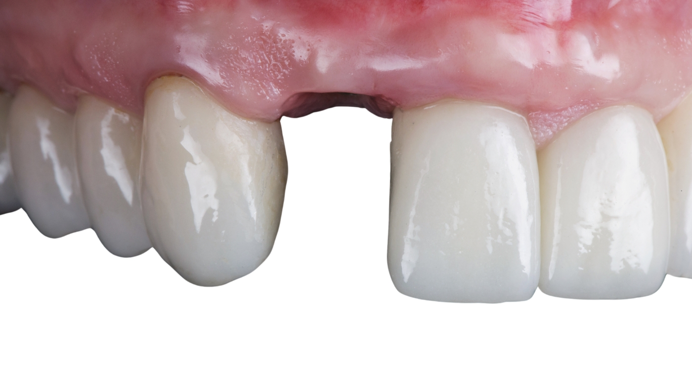 Peri-implant Mucositis: Causes, Symptoms and Treatment