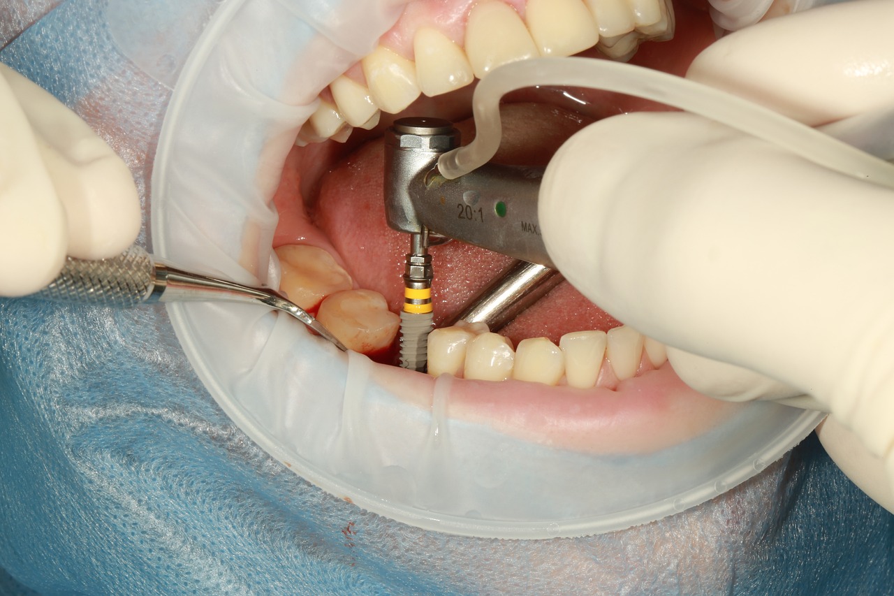 Zirconia Dental Implants: Features, Pros and Cons